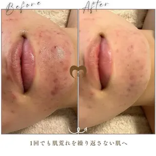 ニキビケア/毛穴/ 赤み/自信の肌✨森園のエステ・リラクイメージ