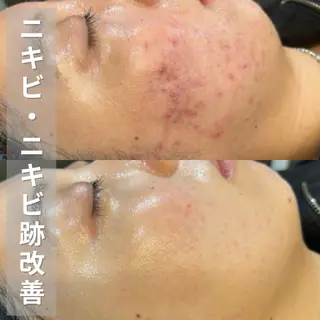 ニキビ・ニキビ跡改善 leoloのエステ・リラクイメージ