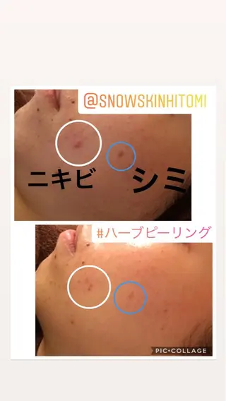 ニキビ/肌質改善専門 Snow skinのエステ・リラクイメージ