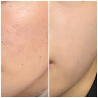 ニキビ特化型エステ 🍓最短で肌質改善のエステ・リラクイメージ