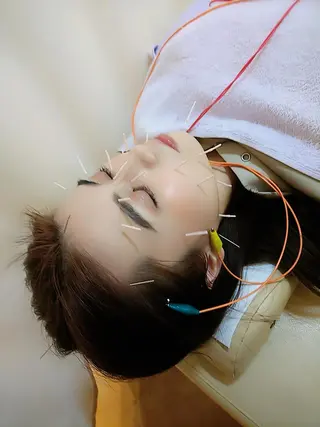 リフトアップ・たるみ ☆美容鍼小顔矯正のその他イメージ