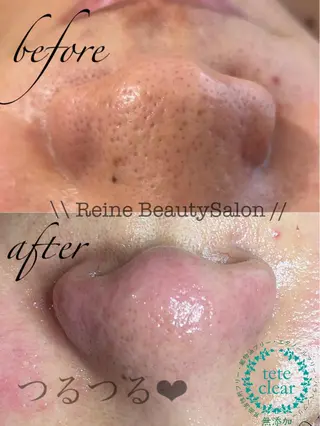 Reine BeautySalon所属・毛穴/シミ肝斑/脱毛 横山梨里のエステ・リラクイメージ