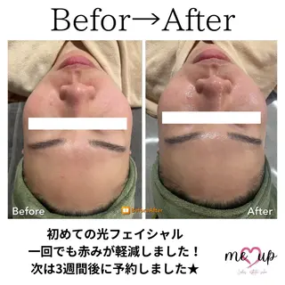 Meupニキビ専門店 背中/ハーブ/肌管理のその他イメージ