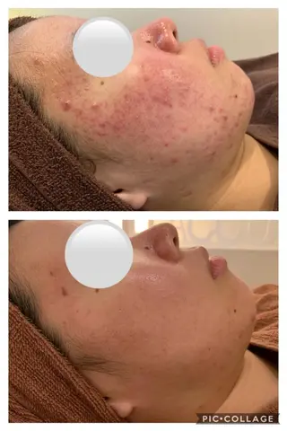 セミロング カラー パーマ ヘアアレンジ メンズ キッズ ネイル マツエク・マツパ アイブロウ 肌質体質を変えて すっぴん肌にのエステ・リラクイメージ