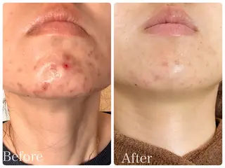 ニキビ・ 肌荒れ専門店のエステ・リラクイメージ