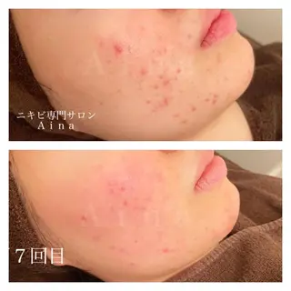 ミディアム カラー パーマ ヘアアレンジ メンズ キッズ ネイル マツエク・マツパ ニキビ跡専門サロン Ａｉｎａのエステ・リラクイメージ