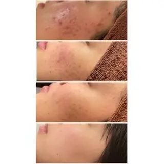 ニキビ特化型エステ 🍓最短で肌質改善のその他イメージ