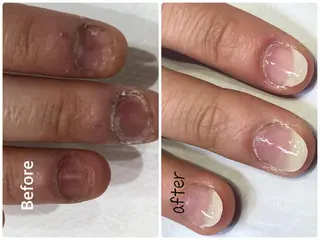 ネイル グレースレディ所属・深爪矯正長さ出し専門 グレースレディのネイルデザイン