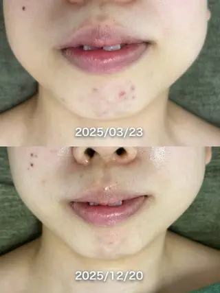 韓国美肌/肌質改善 【天神】yuiのエステ・リラクイメージ