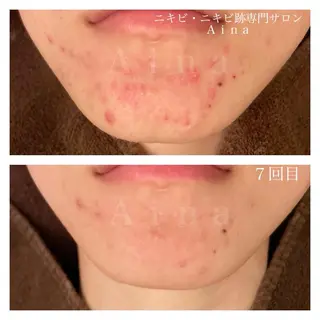 ニキビ跡専門サロン Ａｉｎａのエステ・リラクイメージ