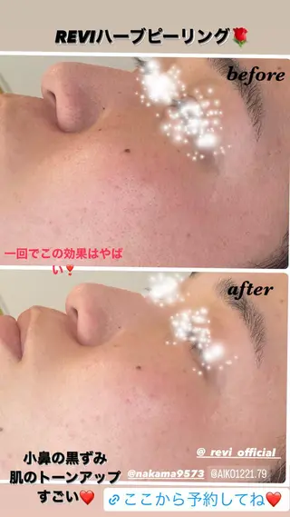 ハーブピーリング/韓国肌管理/フェイシャル/毛穴洗浄/眉毛/顔脱毛【糸脱毛専門】rev所属・ハーブピーリング🌹 毛穴洗浄❤️眉waxのエステ・リラクイメージ