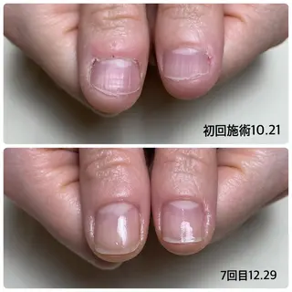 ネイル Nail ビ爪のネイルデザイン