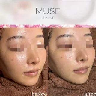 mieux所属・ハーブピーリング ¥6600のエステ・リラクイメージ