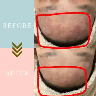 ニキビケア/毛穴/ 赤み/自信の肌✨森園のエステ・リラクイメージ