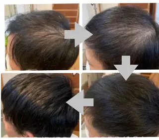 メンズ 抜毛 薄毛 白髪 頭皮改善 柳沢慶のヘアスタイル