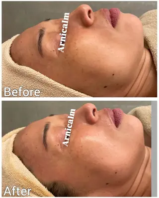 ハーブピーリング 肌再生ピーリング/のエステ・リラクイメージ