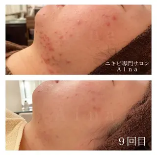 ニキビ跡専門サロン Ａｉｎａのエステ・リラクイメージ