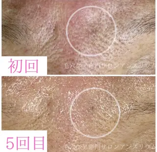 毛穴ケア専門サロンアンスリウム所属・茨城土浦 つくば毛穴 ケア専門サロンのエステ・リラクイメージ