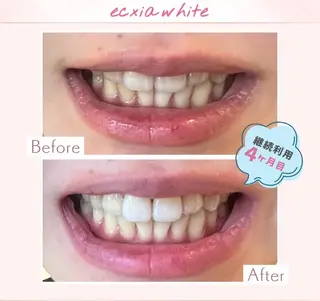 エクシアホワイト調布所属・umi❤︎ ホワイトニングのその他イメージ