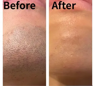 メンズ 医療提携メンズ脱毛 CDFAkasakaのエステ・リラクイメージ