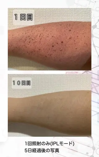 Felice🌸脱毛 ・光フェイシャルのその他イメージ