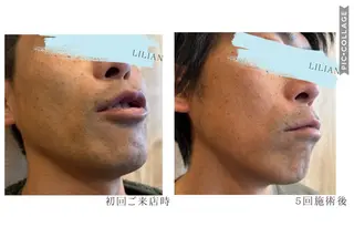 メンズ 脱毛サロン　LILIAN所属・脱毛・美肌サロン LILIAN 脱石油のエステ・リラクイメージ