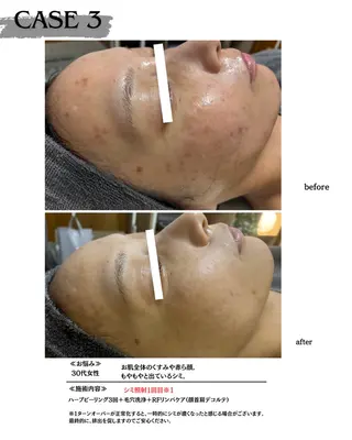 素肌育成・シミケア専門サロン美潤-miulu-所属・【医療提携サロン】 【シミケア専門】のエステ・リラクイメージ