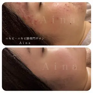 ニキビ跡専門サロン Ainaのエステ・リラクイメージ