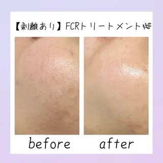 ニキビ改善シャルム ココハーブピーリングのエステ・リラクイメージ