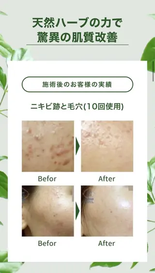 💠mariange💠(脱毛・ハーブピーリング)所属・mariange 〜美肌・美容脱毛〜のエステ・リラクイメージ