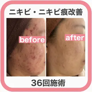 キッズ マツエク・マツパ アイブロウ ニキビ・肌質改善専門 ♡人生が変わるサロンのエステ・リラクイメージ