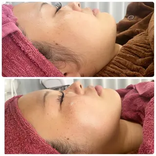 Chalon所属・REVI取扱・肌悩み 毛穴Chalonのエステ・リラクイメージ