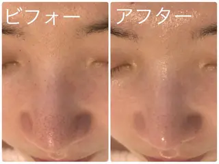 ニキビ･毛穴悩み特化 /CHISATOのエステ・リラクイメージ