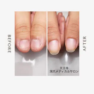 ネイル 天王寺 深爪メディカルサロンのネイルデザイン