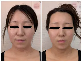 レチノール/ニキビ/ 毛穴ケア 浅川のエステ・リラクイメージ