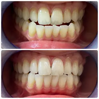 White Berry SELF BEAUTY SALON所属・セルフホワイトニング 🦷口元垢抜け✨のその他イメージ