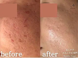 毛穴&ニキビ専門　Bonita Ange恵比寿所属・毛穴ニキビ専門 BonitaAngeのエステ・リラクイメージ