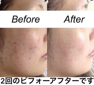 ミディアム カラー パーマ ヘアアレンジ キッズ ネイル マツエク・マツパ 都度払い肌質改善 &脱毛Blancheのエステ・リラクイメージ