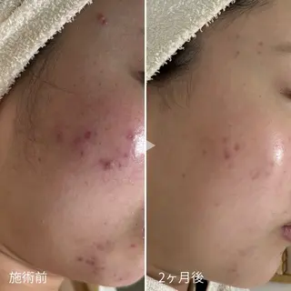シェノン所属・ニキビ・毛穴・ フェイシャル専門店のエステ・リラクイメージ