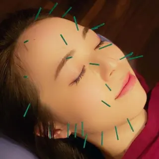 小顔美容鍼灸Acubelle Yakuin.【アキュベル薬院】所属・石川 真梨奈  美容鍼灸/アロマのエステ・リラクイメージ