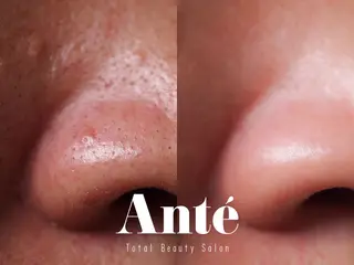 ハーブピーリング肌 管理🌿Ante関内のエステ・リラクイメージ