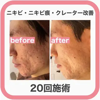 ニキビ跡改善専門🔥 医療にはできない改善のエステ・リラクイメージ