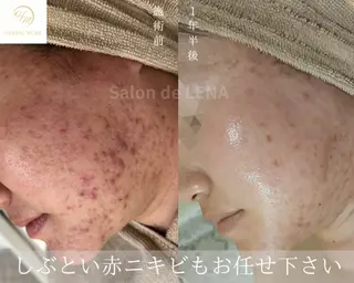 ハーブピーリング・毛穴ケア専門サロンSalon de LENA 栄店所属・ハーブピーリング専門 サロンドレナ　白藤のエステ・リラクイメージ