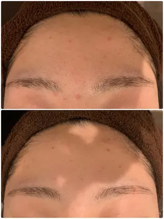 肌質改善ハーブピー リング🌿RINAのエステ・リラクイメージ