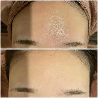 ニキビ特化型エステ 🍓最短で肌質改善のエステ・リラクイメージ