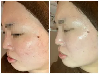 ニキビ･毛穴悩み特化 /CHISATOのエステ・リラクイメージ