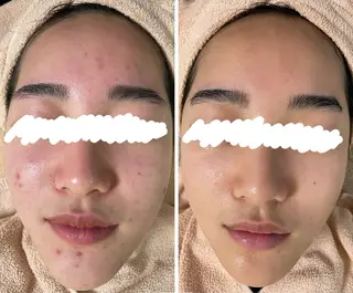 ニキビ&跡改善サロン オーナー光木のエステ・リラクイメージ