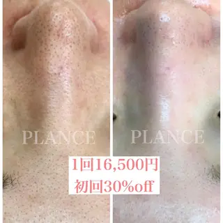 フェイシャル専門 肌質改善/プランスのエステ・リラクイメージ