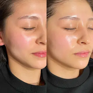 mieux所属・ハーブピーリング ¥6600のエステ・リラクイメージ