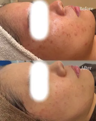 BELLIS HUIT所属・ハーブピーリング那覇 BELLISHUITのエステ・リラクイメージ